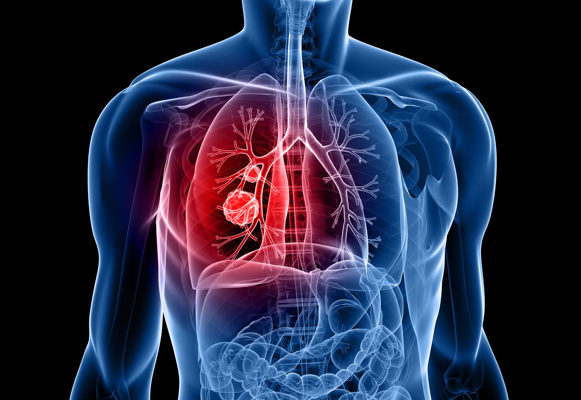 Life extending Drug For Chronic Lung Disease Available On The NHS UK 