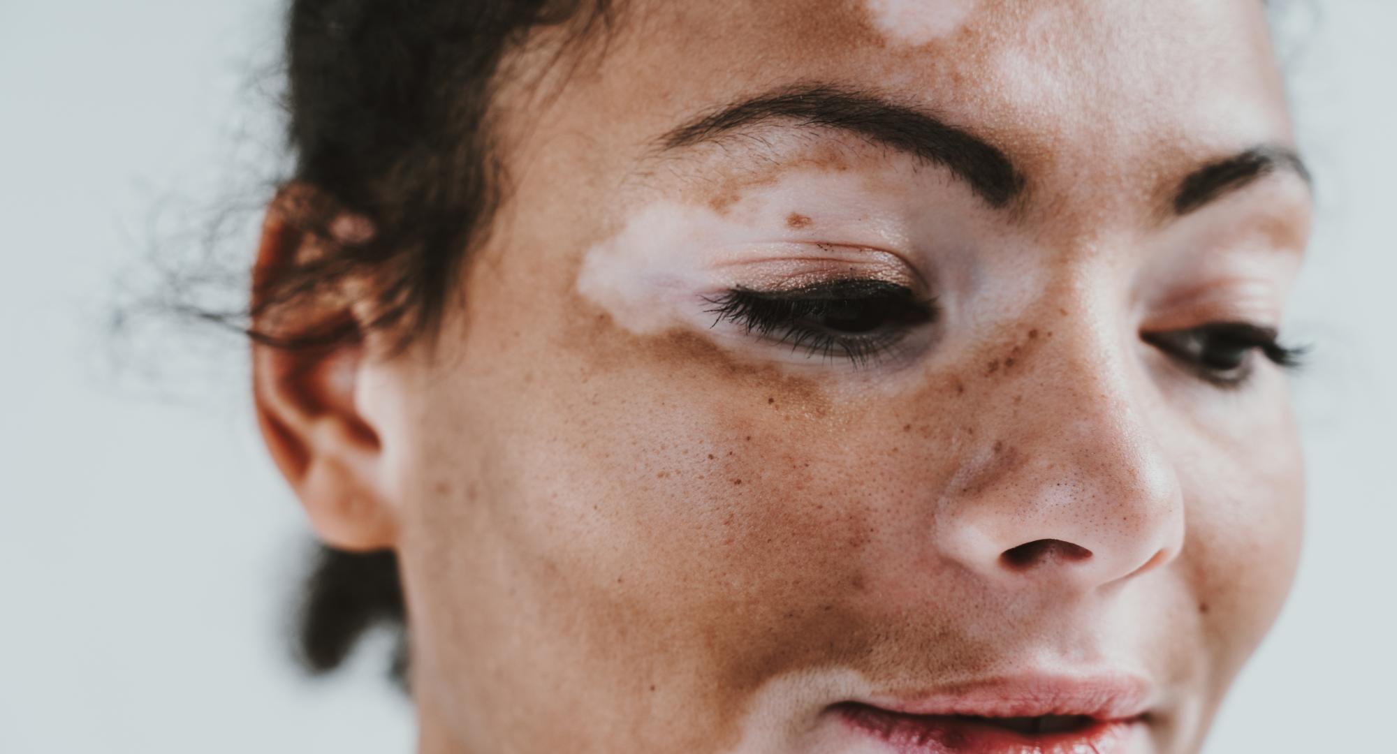 Woman with facial vitiligo