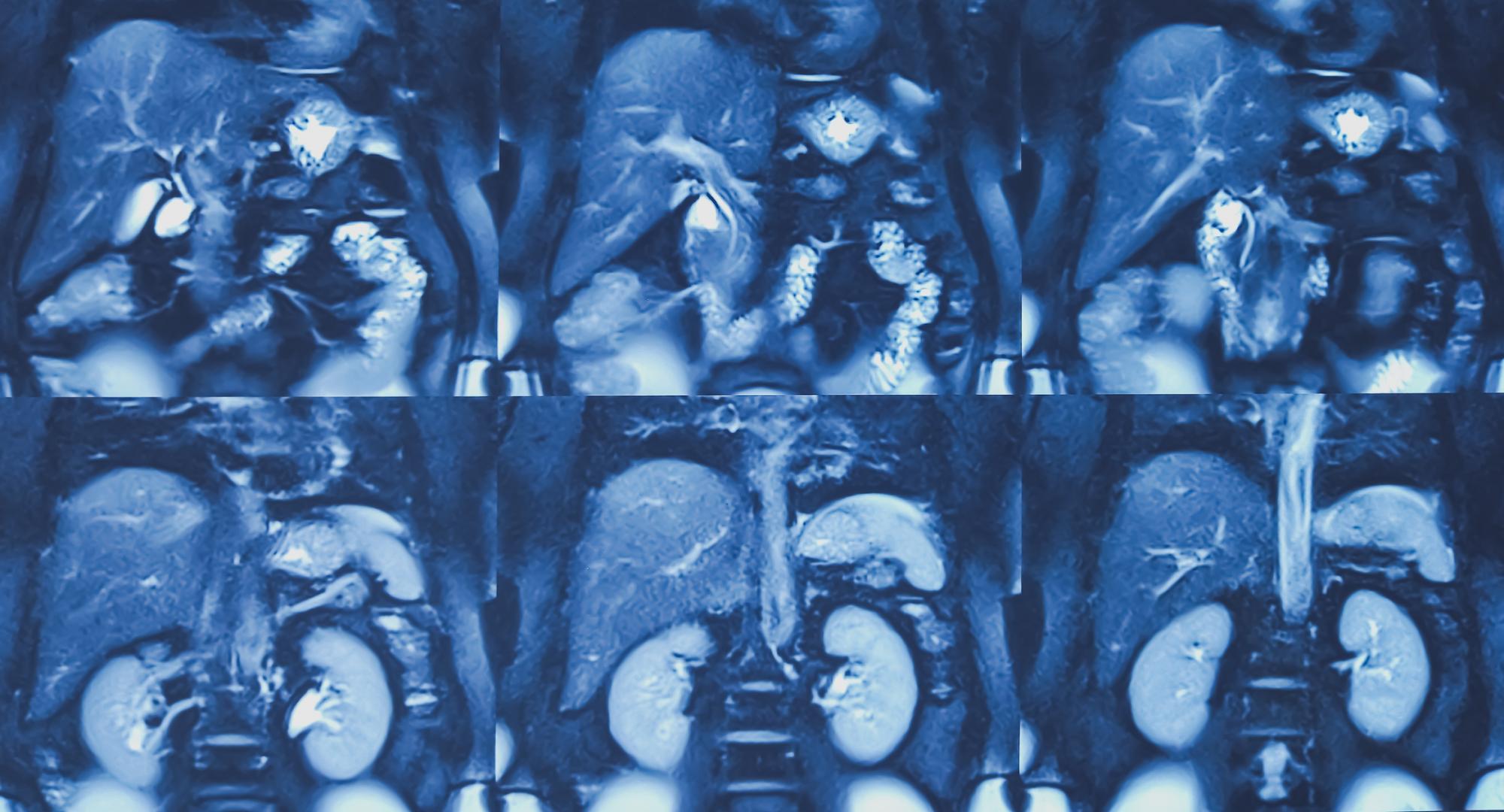 MRI image including bile duct