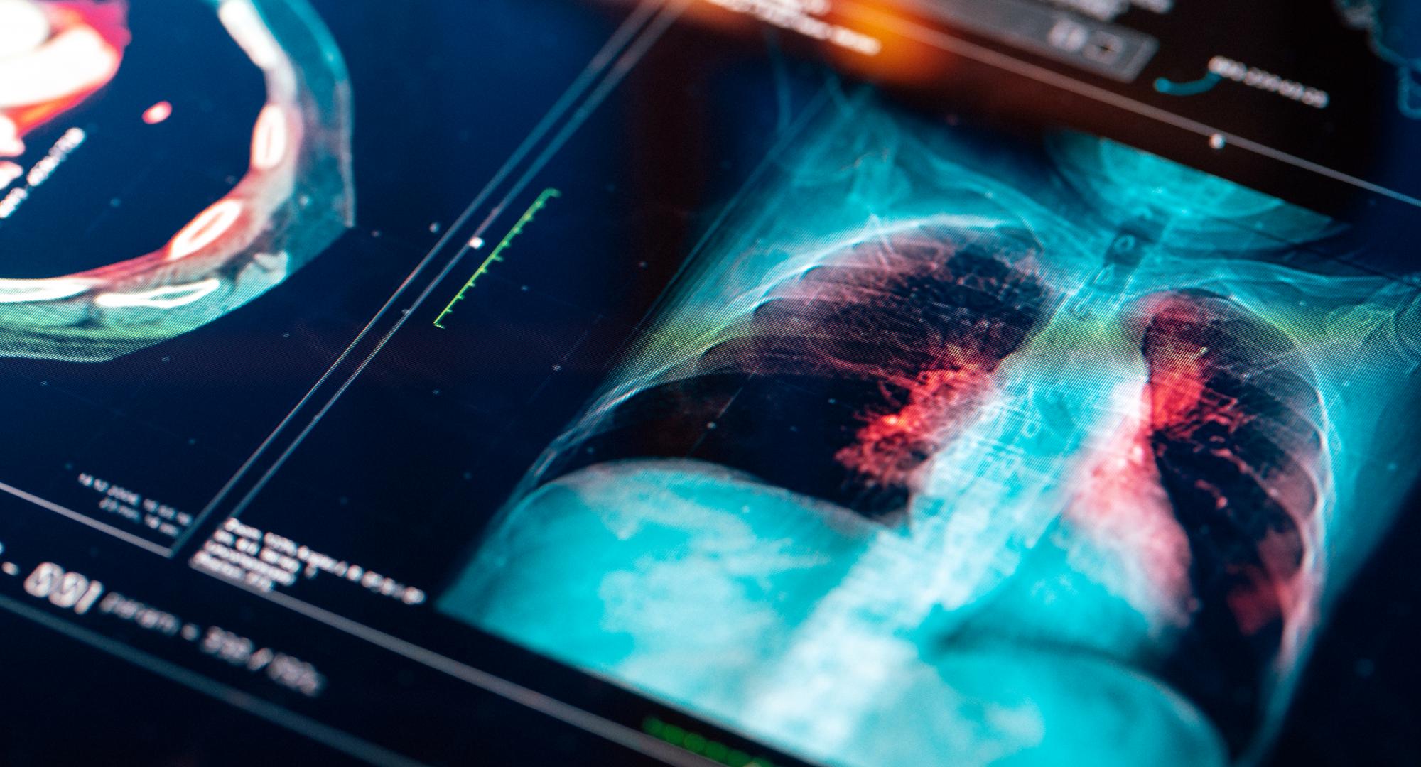 The Medicines and Healthcare products Regulatory Agency has approved lurbinectedin (Zepzelca) for use in combination with atezolizumab as a maintenance treatment for adults with extensive-stage small cell lung cancer (SCLC) whose disease has not progressed following first-line induction therapy. The decision marks an important development for patients with one of the most aggressive forms of lung cancer, offering a new treatment option after initial therapy with atezolizumab, carboplatin and etoposide. Lurb