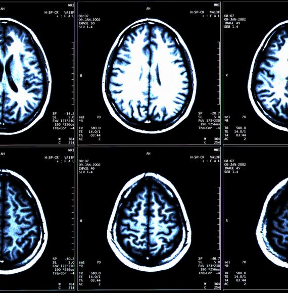 Multiple sclerosis